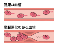 血管病のスクリーニング